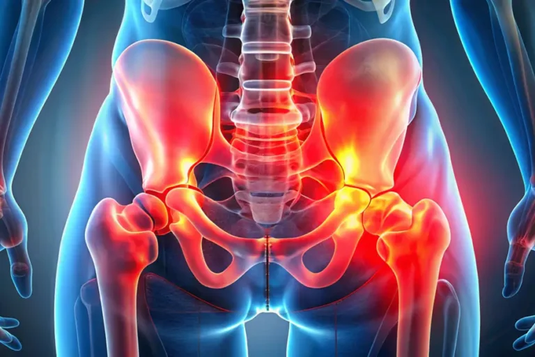 Eine anatomische 3D-Darstellung des menschlichen Beckens und der unteren Wirbelsäule mit hervorgehobenen Iliosakralgelenken (ISG). Die rot leuchtenden Bereiche zeigen schmerzhafte oder entzündliche Stellen, die auf eine ISG-Blockade oder Gelenkprobleme hinweisen.