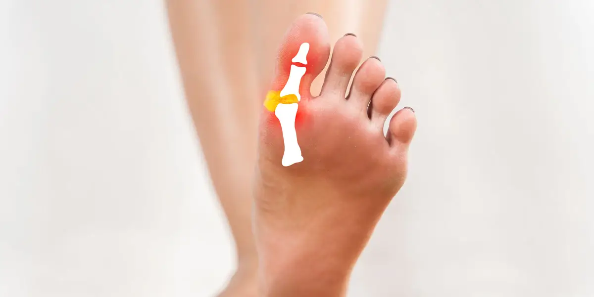 Nahaufnahme eines nackten Fußes von unten, bei dem das Großzehengelenk mit einer weiß-gelben Markierung und roter Entzündung optisch hervorgehoben ist – Symbolbild für Hallux valgus.